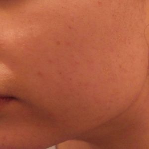 image after the mask